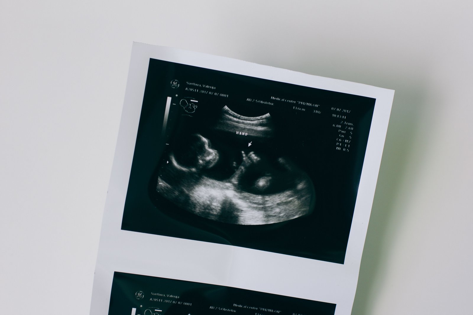 Imagen de ultrasonografía obstétrica de un bebé